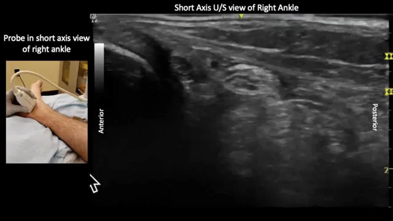 Ultrasound Guided Posterior Tibial Nerve Block And Foreign USRA