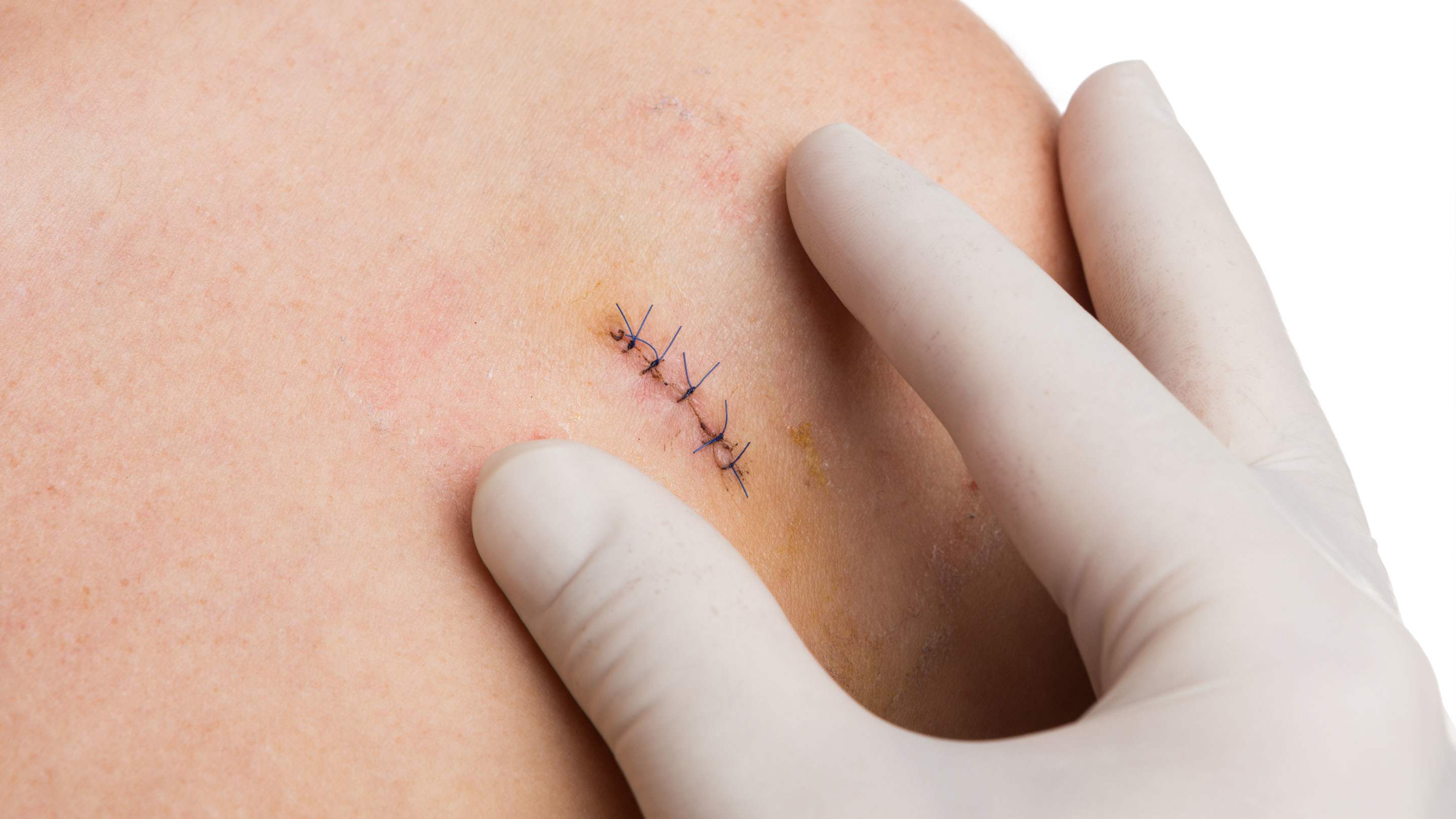 Skin Biopsy and Suturing online CME | AAFP