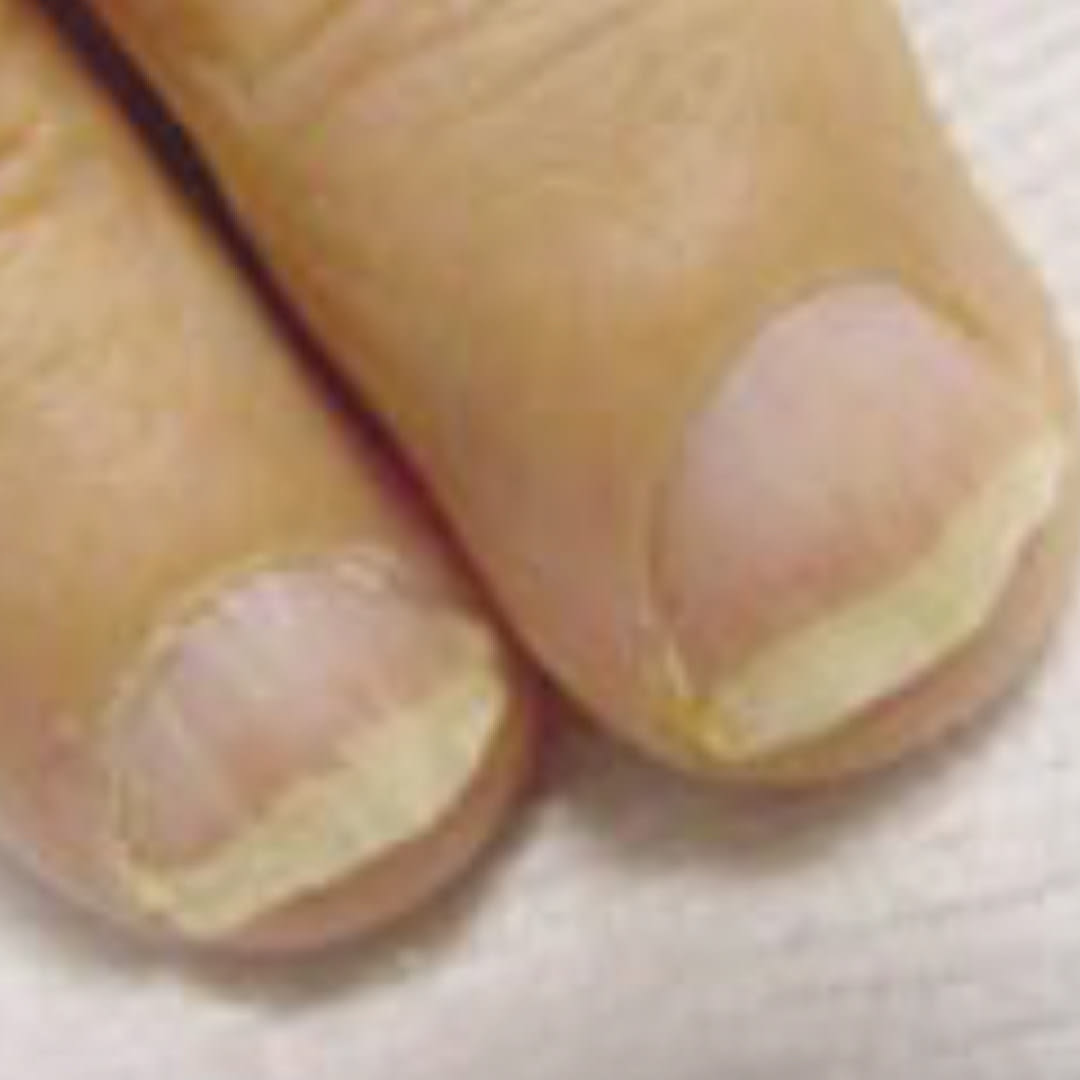 Nail Abnormalities | AFP