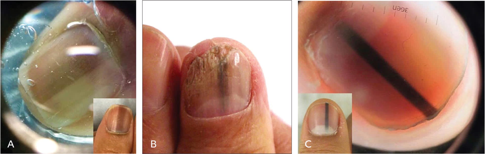 melanotic whitlow causes Nail Abnormalities