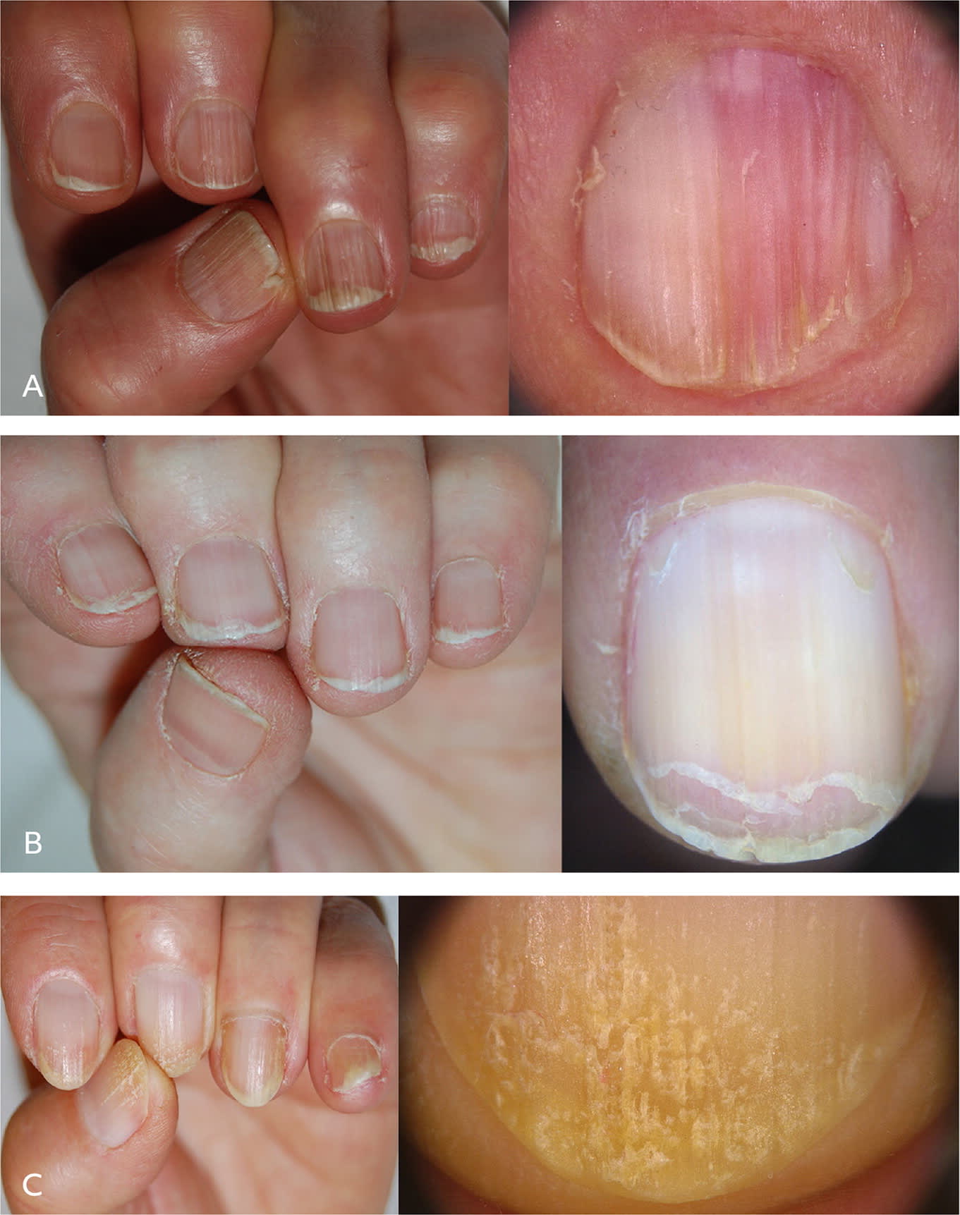 Nail Abnormalities | AFP