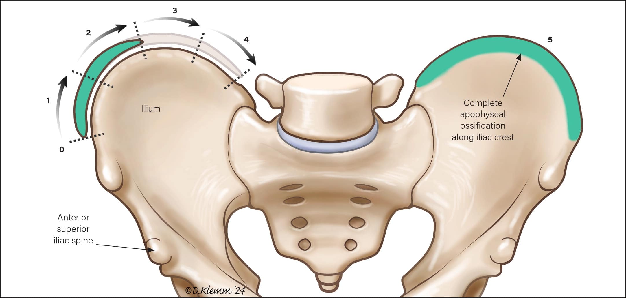 Adolescent Idiopathic Scoliosis - Musculoskeletal Issues in Children ...