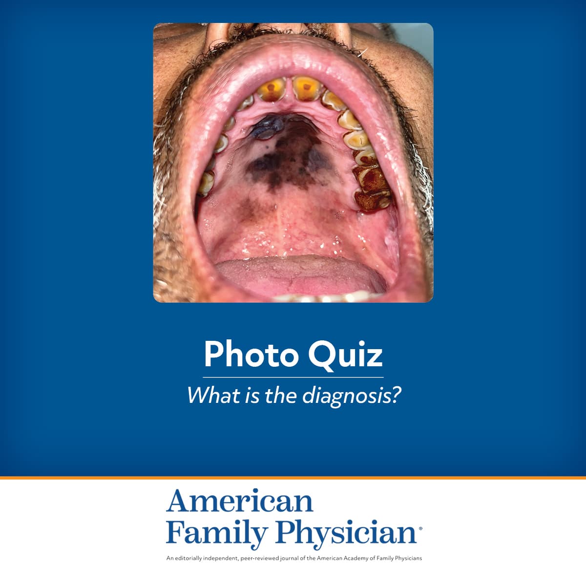 Pigmented Lesion on the Hard Palate | AFP
