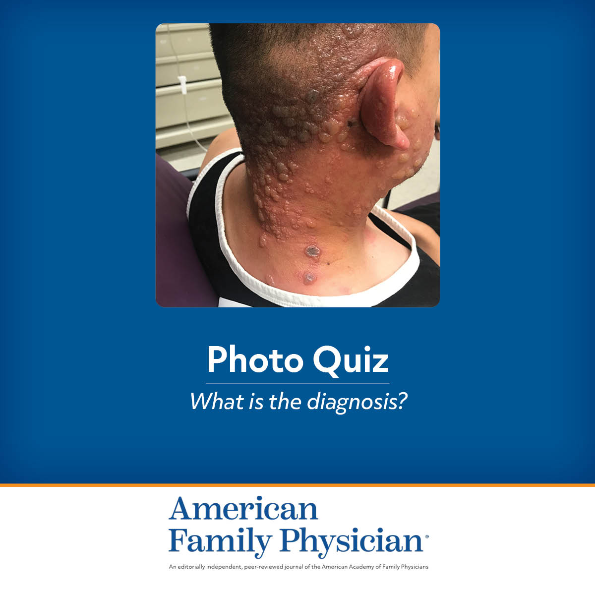 Bullous Rash on the Face and Neck | AFP