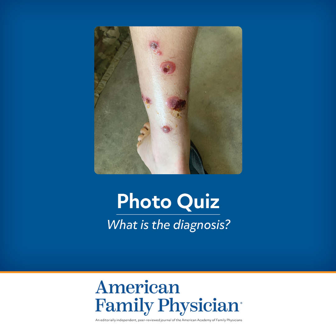 Bullous Rash on the Legs | AFP