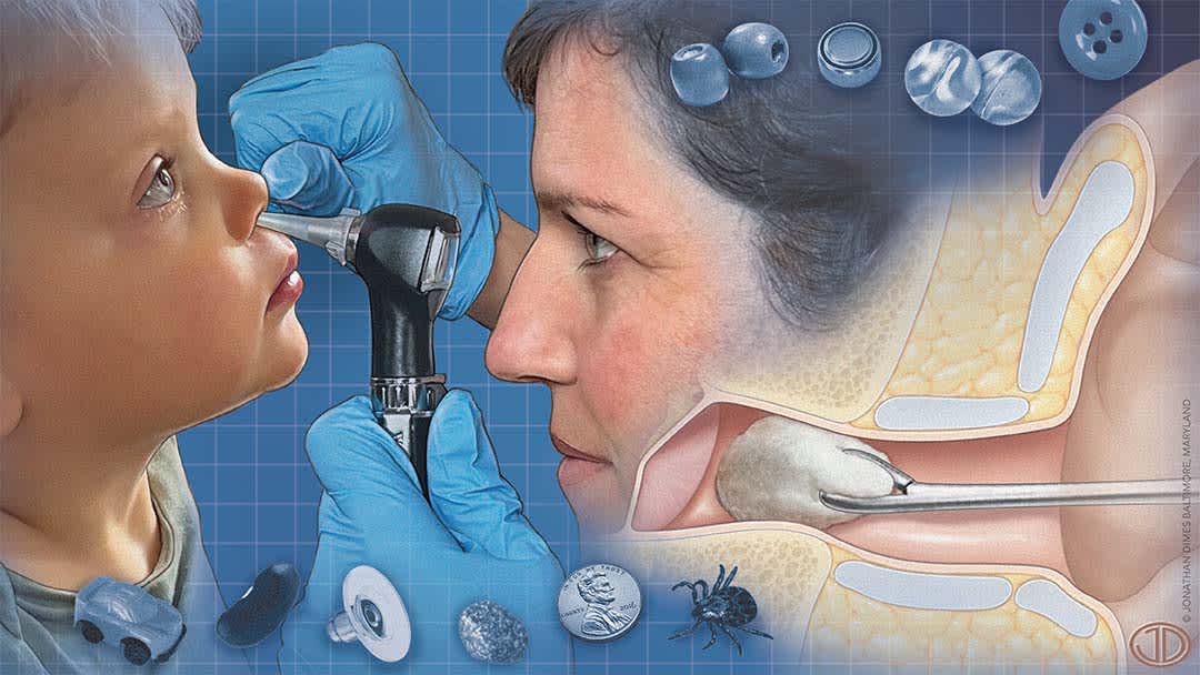 Foreign Bodies in the Ear, Nose, and Throat | AFP