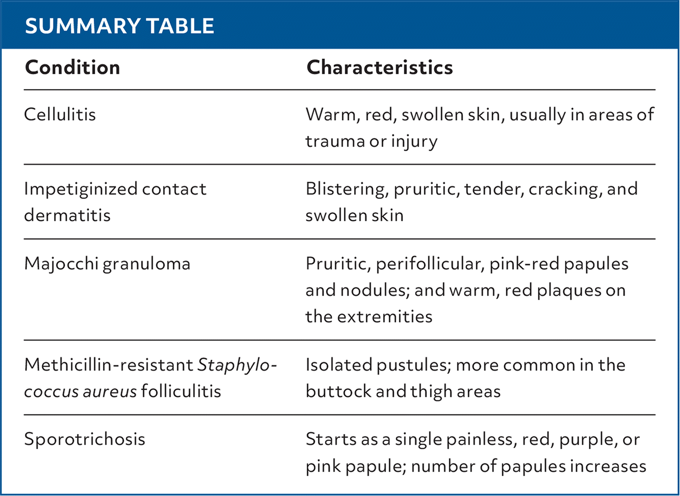 Pruritic Rash Exacerbated by Steroid Cream | AFP