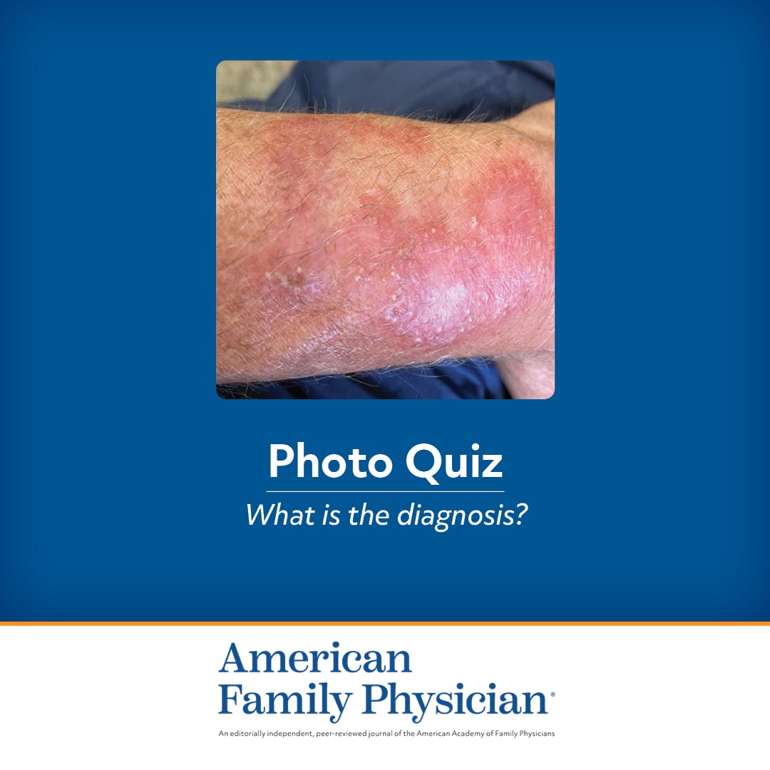 Pruritic Rash Exacerbated by Steroid Cream | AFP