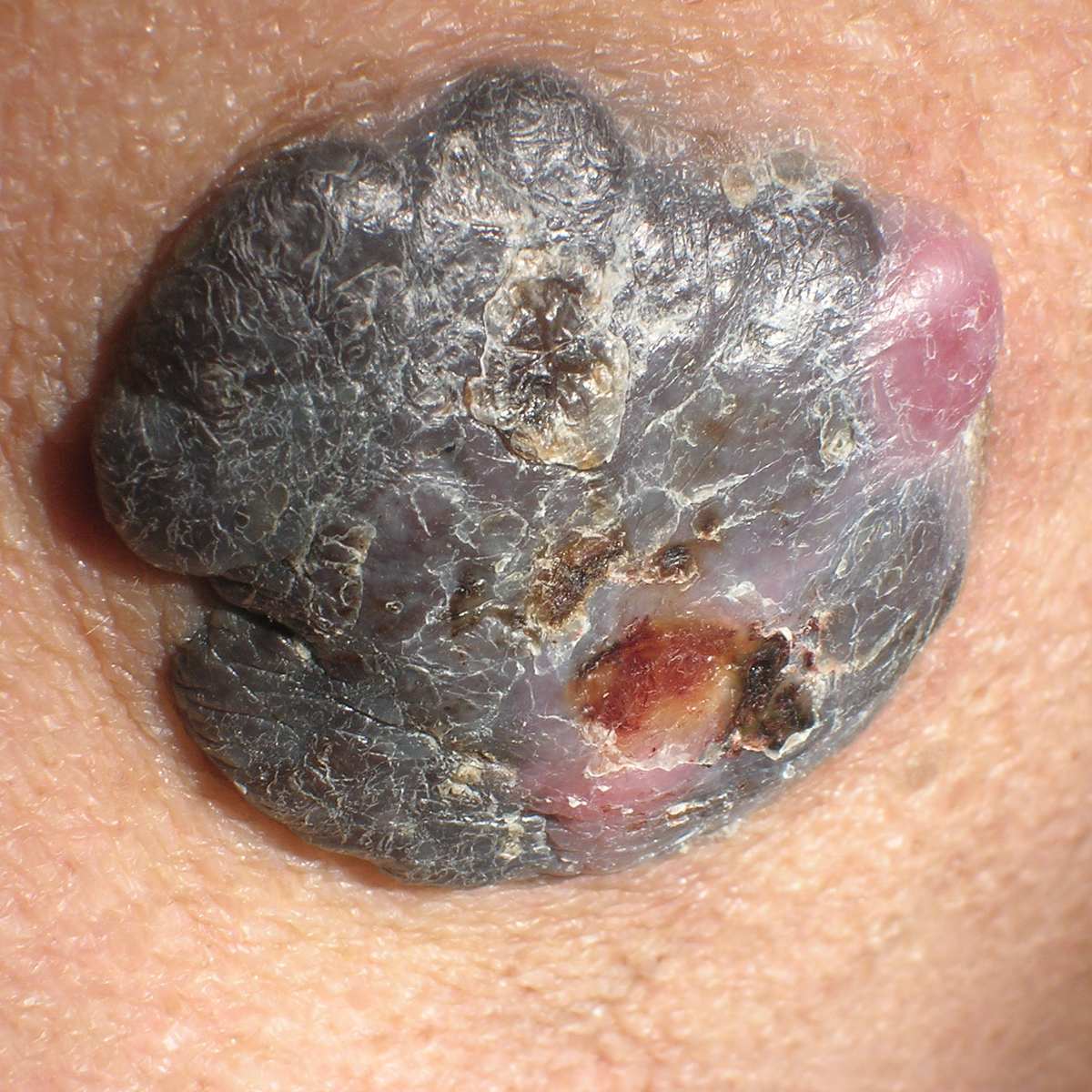 melanotic skin cancer Melanoma — Dermatology of North Asheville
