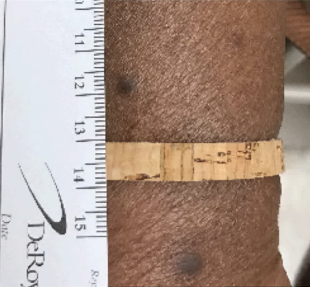 Diagnosing Common Benign Skin Tumors | AFP