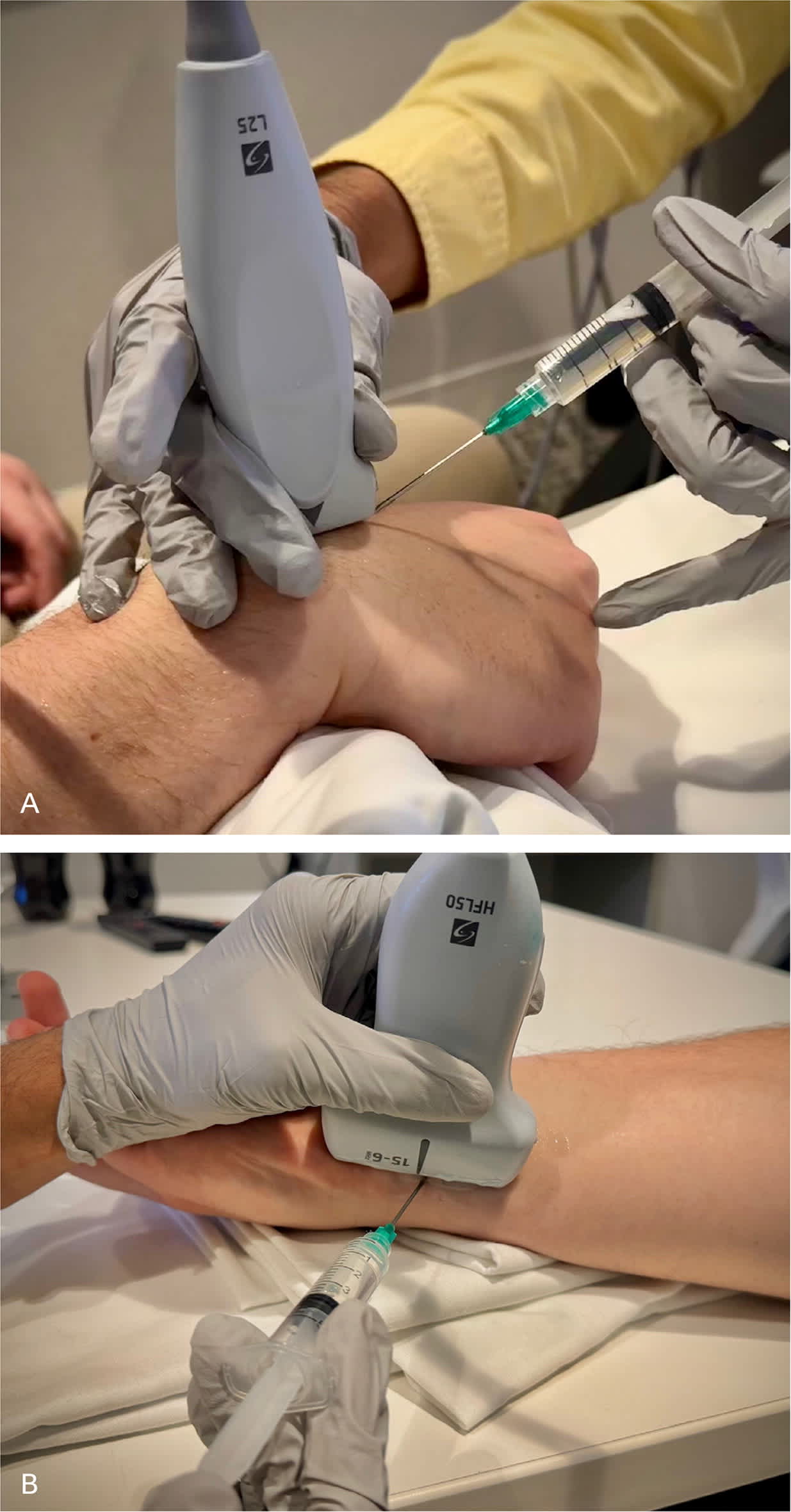 Intersection Injection Injections of the Hand and Wrist: Part II. Carpal Tunnel Syndrome ...