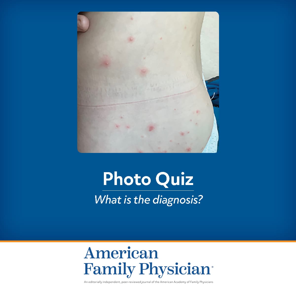 School Absence Rash Rash in a School-Aged Child | AFP
