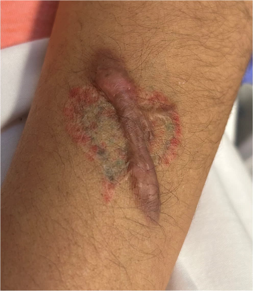 Management of Keloids and Hypertrophic Scars | AFP