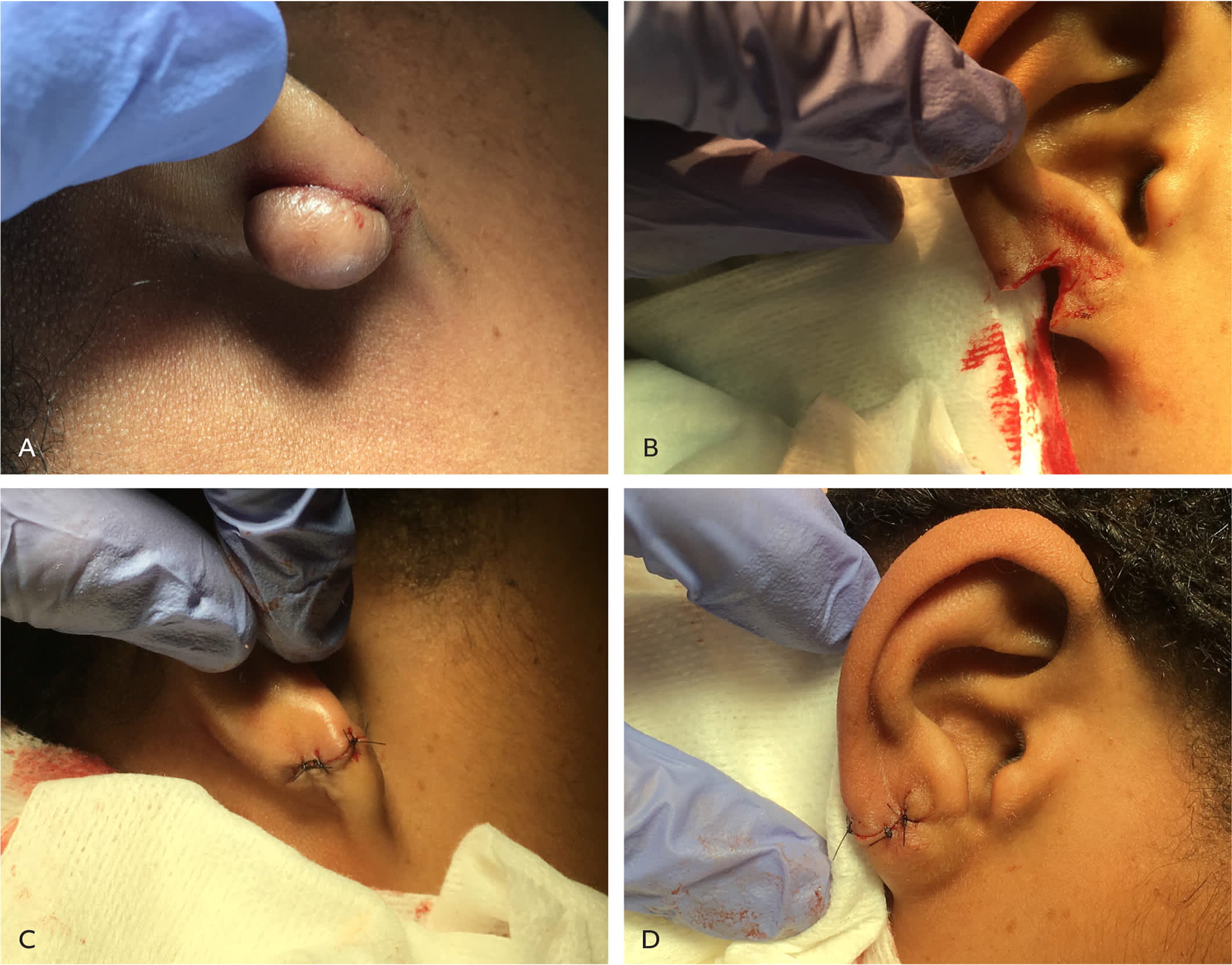 Management of Keloids and Hypertrophic Scars | AFP