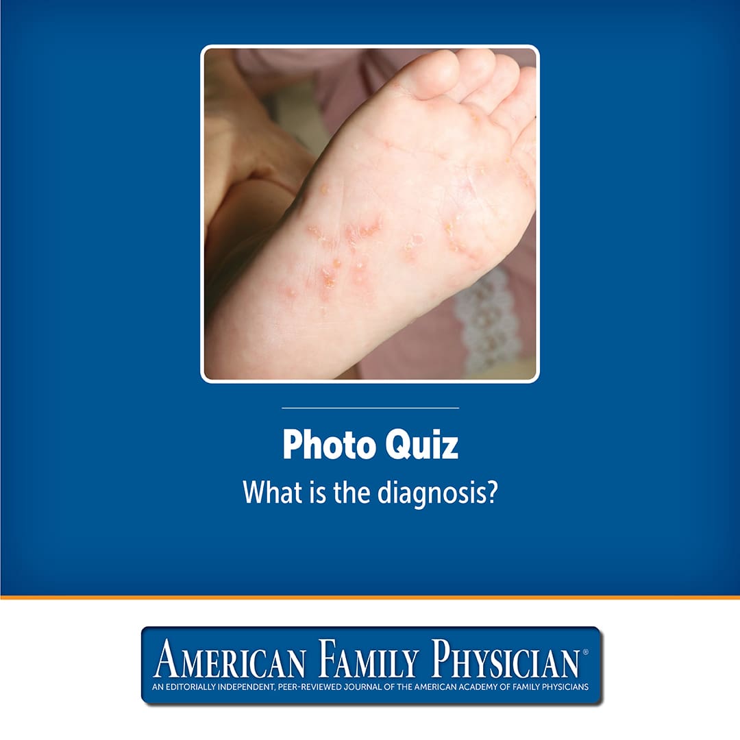 Tiny Vesicles and Papules on the Soles of an Infant | AFP