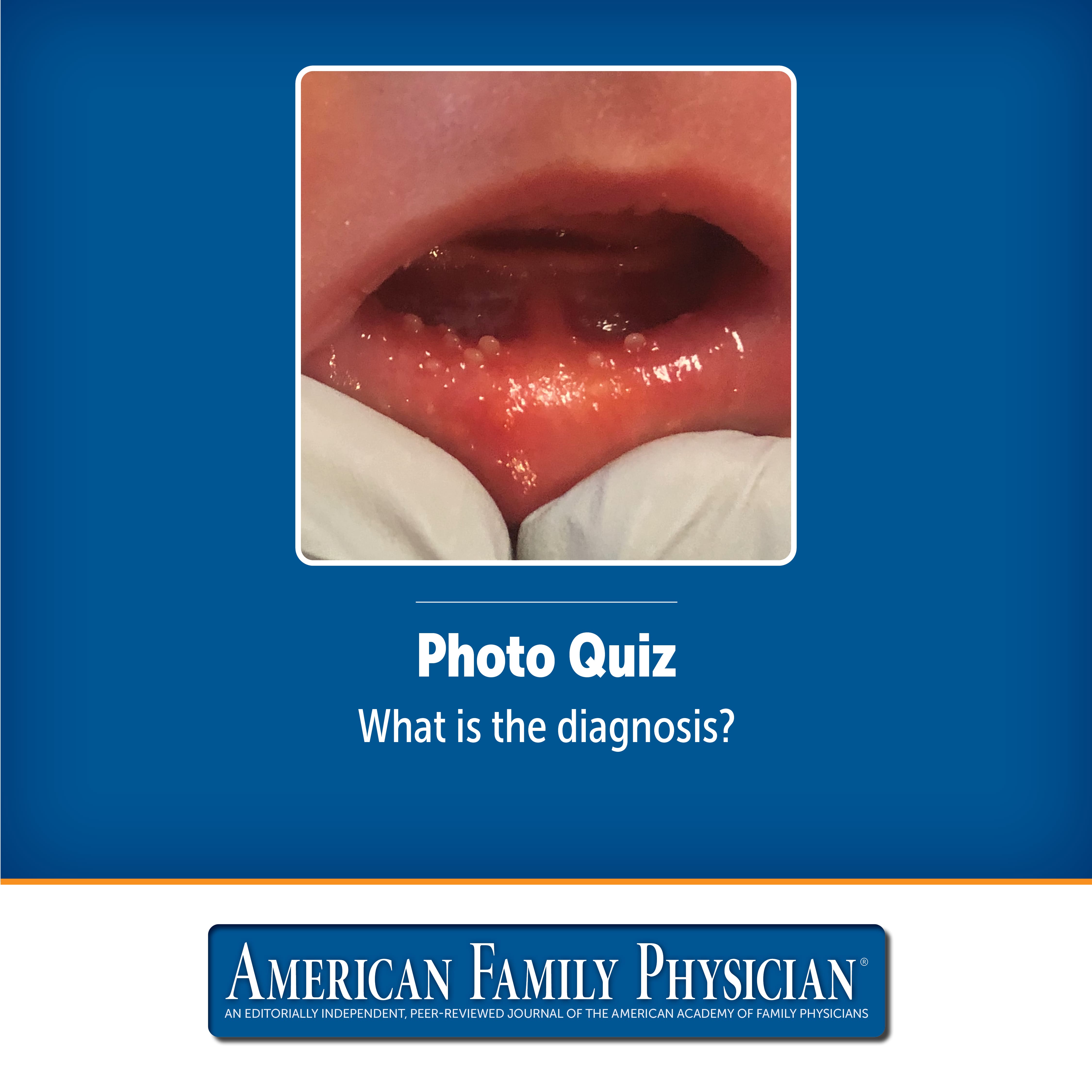 Intraoral Lesions in a Newborn | AFP