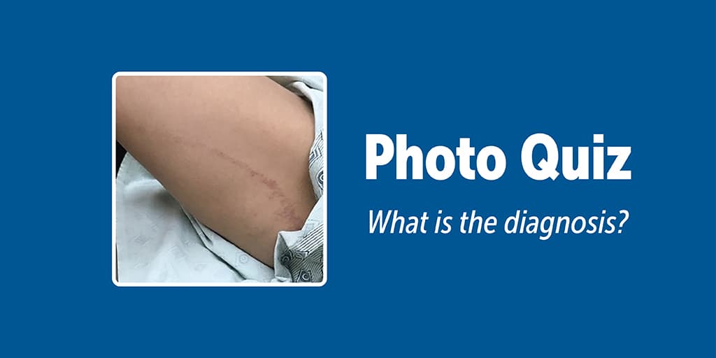 Random Individual Rash Fits A Disseminated Rash on the Upper Body | AFP
