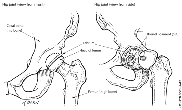 Hip Impingement: What You Should Know | AFP