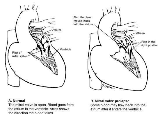 What You Should Know About Mitral Valve Prolapse | AFP