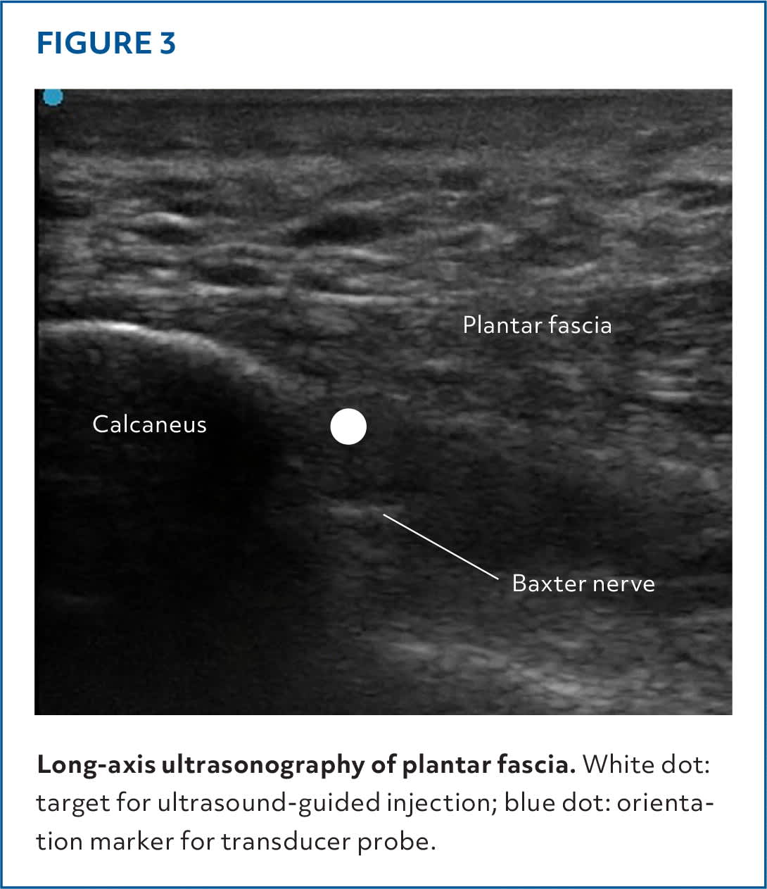 Pocus Foot Injection Injections of the Foot and Ankle | AFP