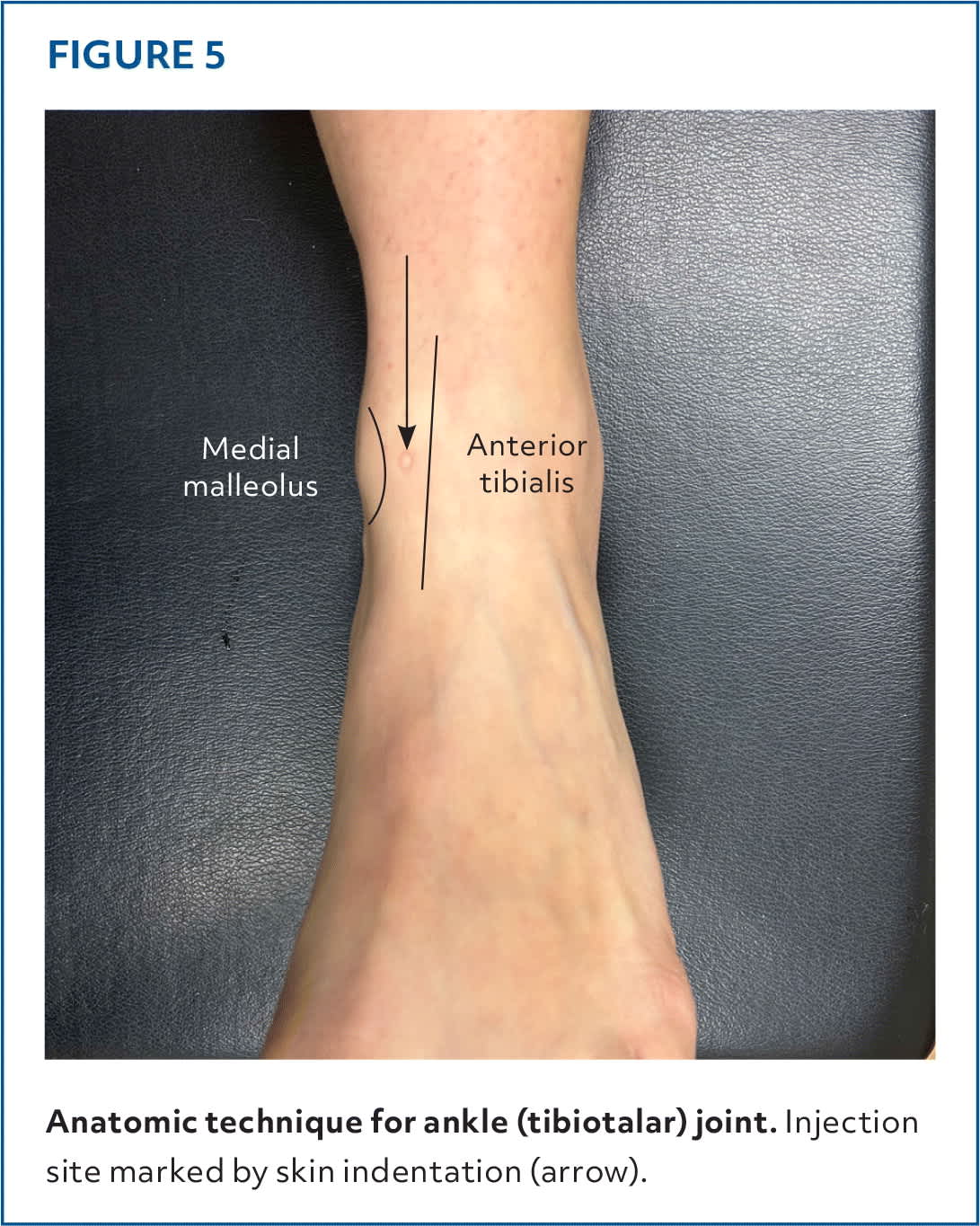 Injections of the Foot and Ankle | AFP