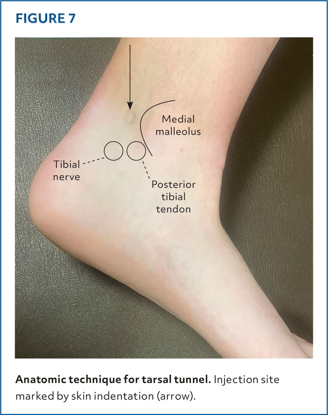 Injections of the Foot and Ankle | AFP