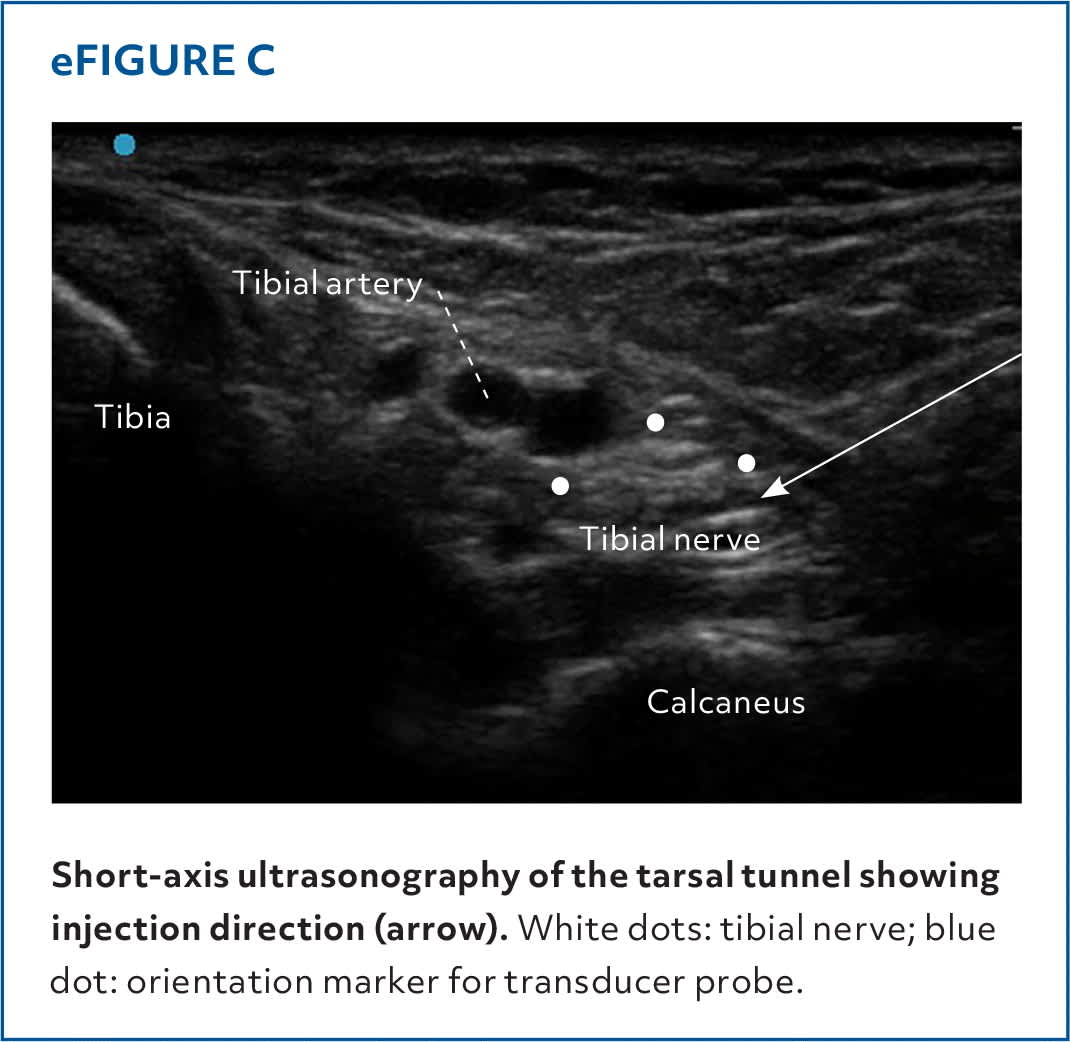 Injections of the Foot and Ankle | AFP