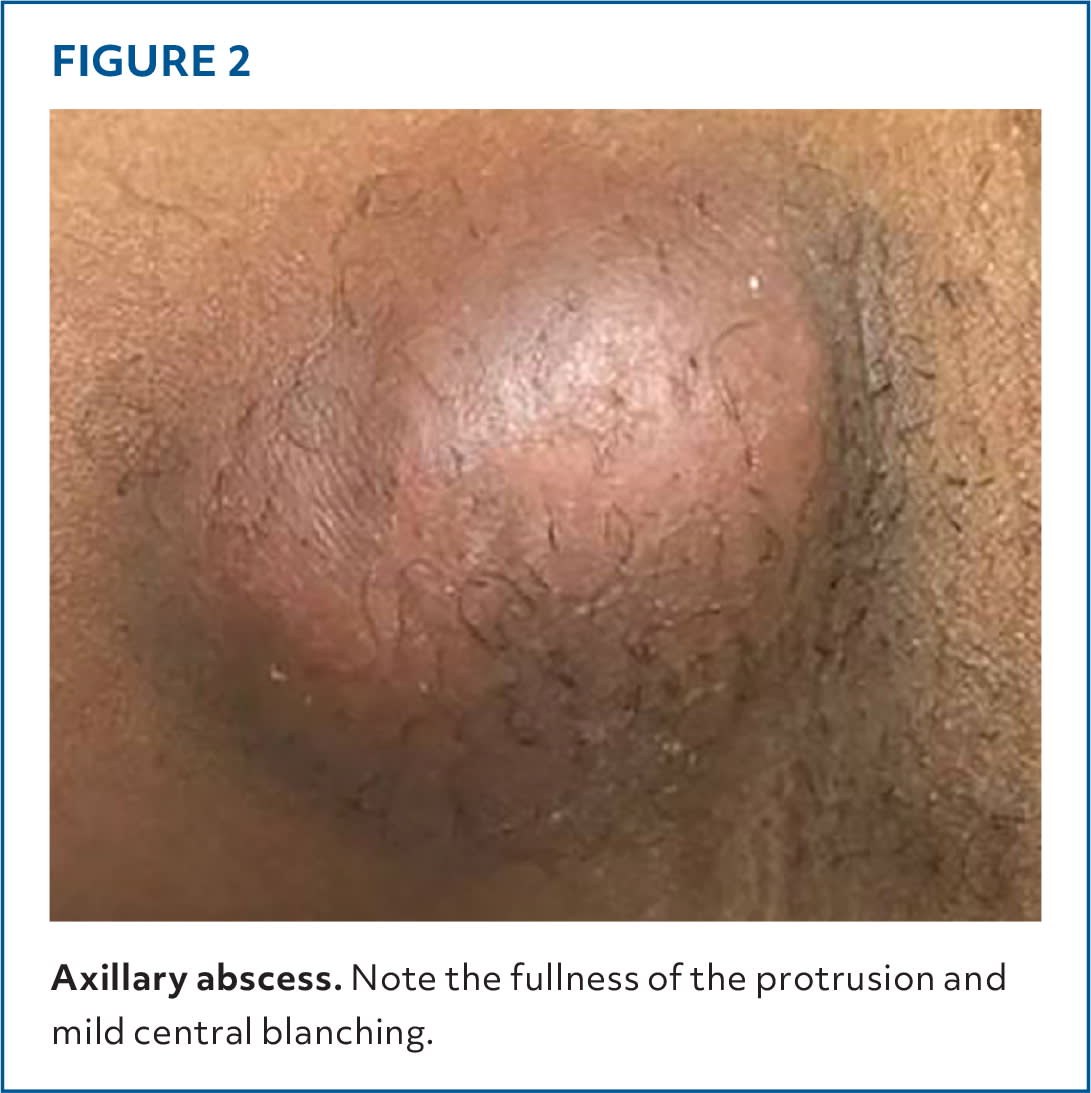 Skin and Soft Tissue Infections | AFP