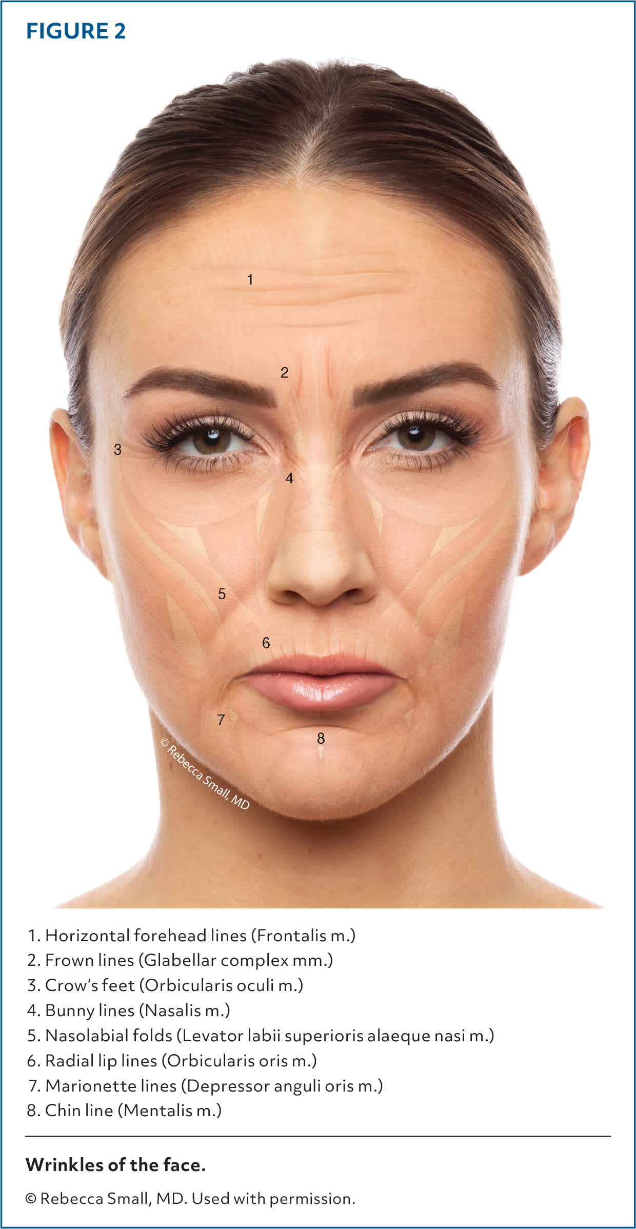 Botulinum Toxin Procedures: A Practical Approach to Cosmetic Injections ...