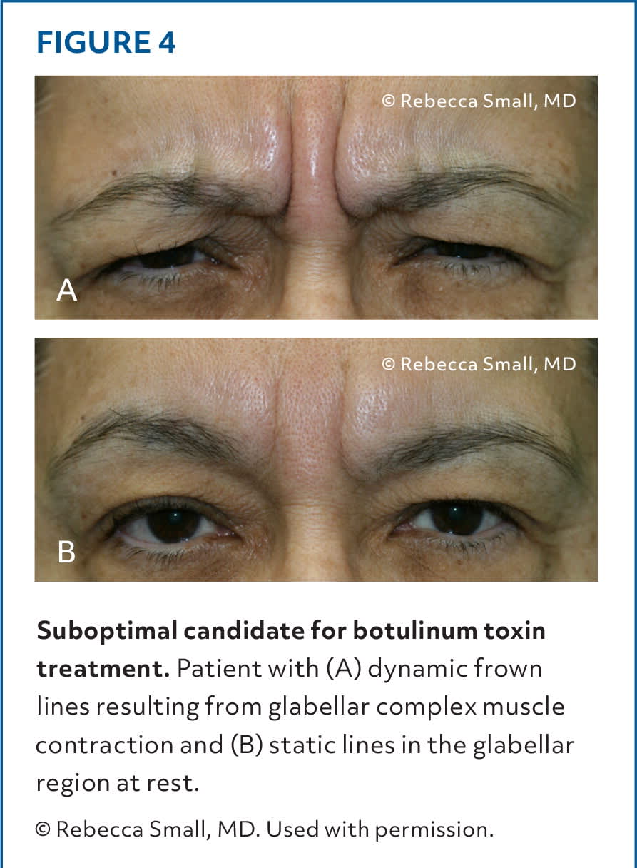 Botulinum Toxin Procedures: A Practical Approach to Cosmetic Injections ...